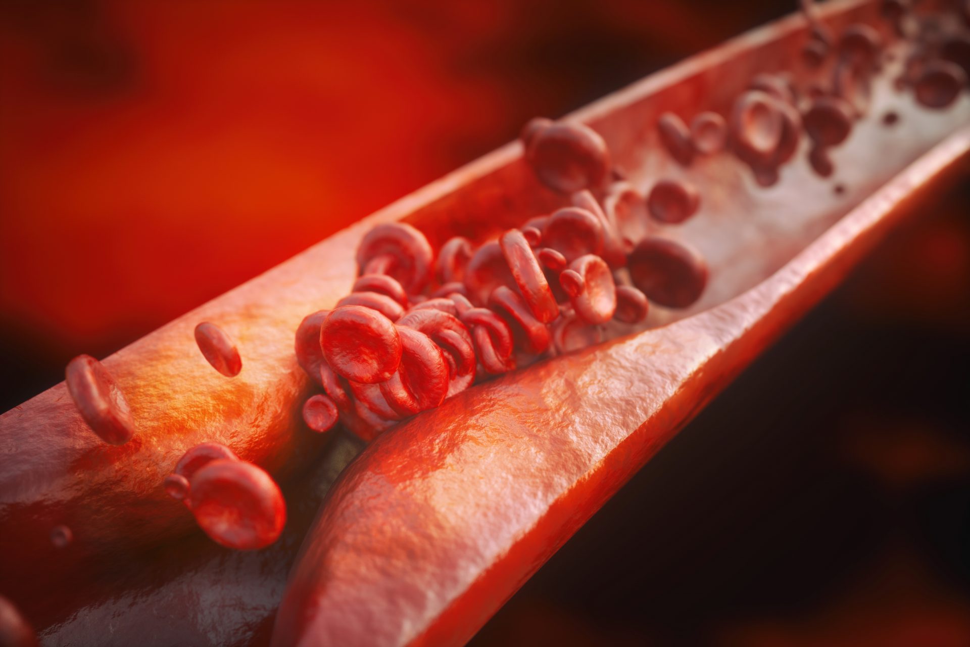 Atherosclerosis Featured Image